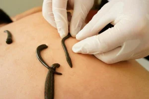 Leech Therapy