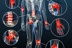 Osteoarthritis Osteoarthritis
